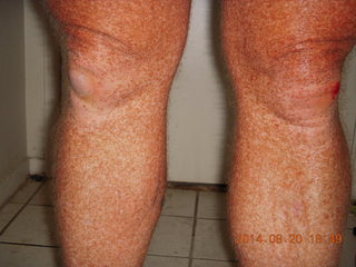 Adam's knee X-ray 1