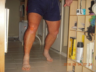 two days after my knee surgery