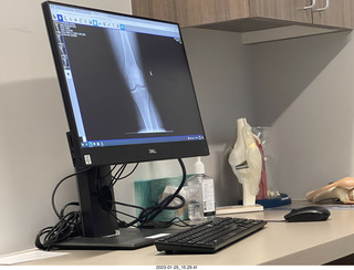 my knee x-ray