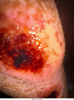 knee surgery images