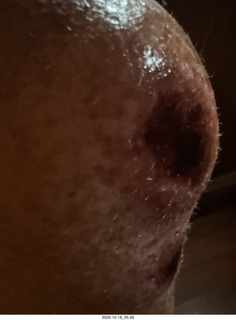 Adam's bloody knee